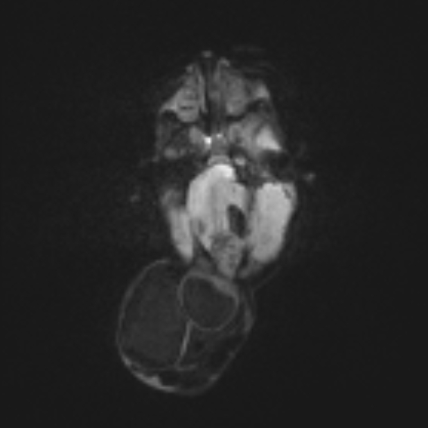 Chiari Iii Malformation With Occipital Encephalocele Image