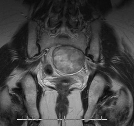 Sacral schwannoma | Image | Radiopaedia.org