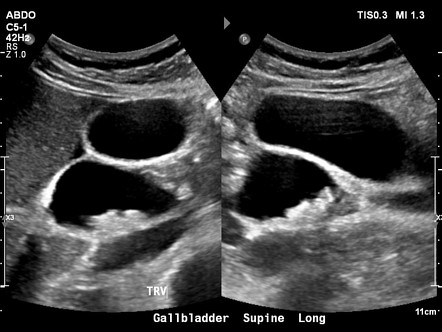 Choledocholithiasis and choledochal cyst | Radiology Case | Radiopaedia.org