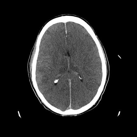 hypoxic encephalopathy radiopaedia ischemic radiology ischaemic