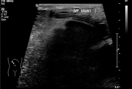 Anterior abdominal wall CSF pseudocyst (CSFoma) | Image | Radiopaedia.org