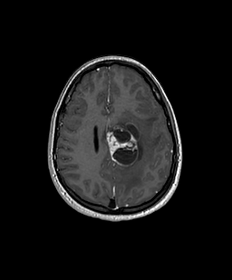 Angiomatous Meningioma Image Radiopaedia Org