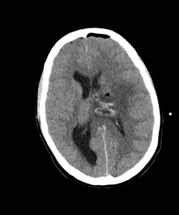 Angiomatous meningioma | Image | Radiopaedia.org