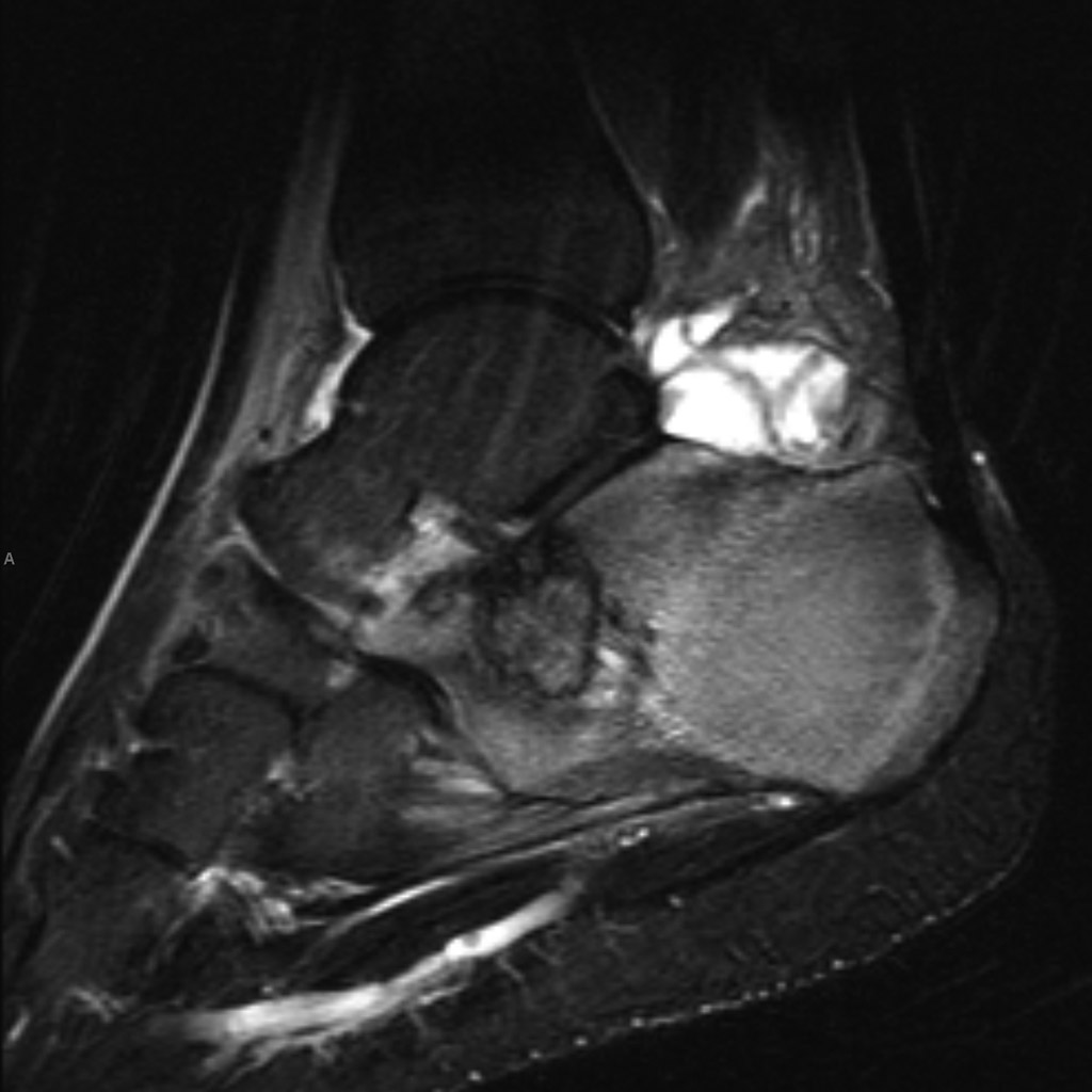 Chondroblastoma- Calcaneum 