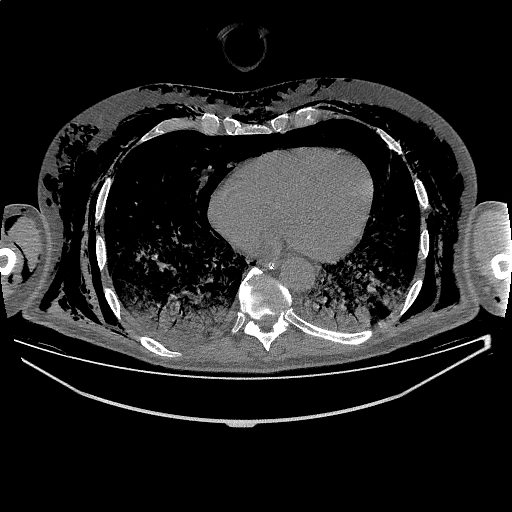 File:Pneumothorax, pneumomediastinum, pneumoperitoneum and subcutaneous ...