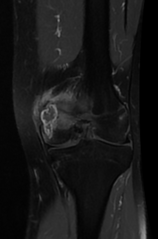 Chondrosarcoma - knee | Image | Radiopaedia.org