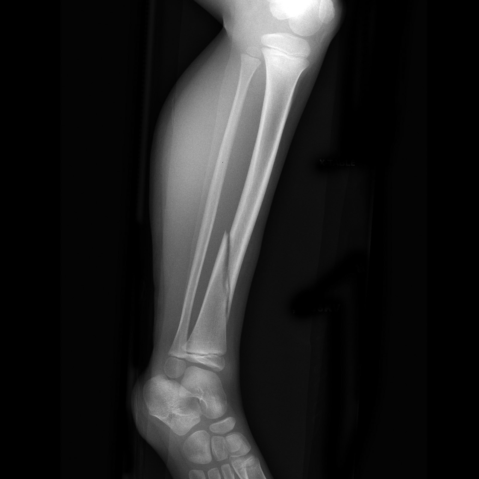 spiral fracture of tibia and fibula recovery time