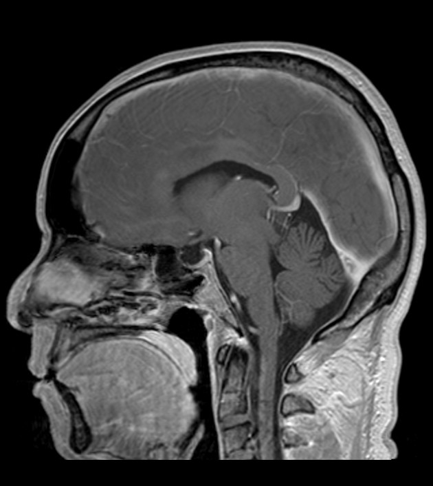 Tuberculoma | Image | Radiopaedia.org