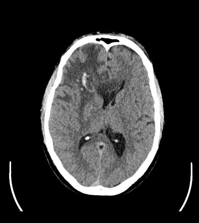 Tuberculoma 