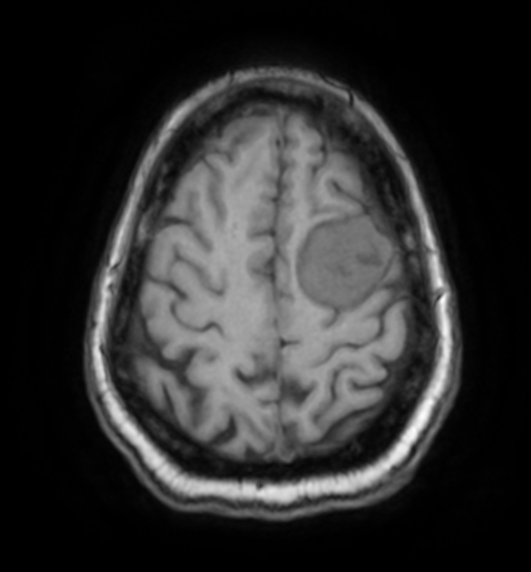 Meningioma | Radiology Reference Article | Radiopaedia.org