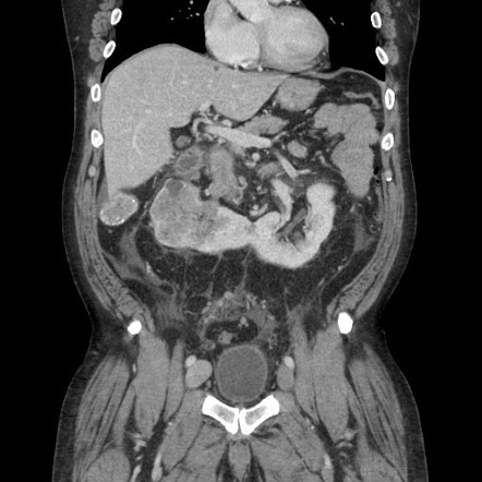 Renal cell carcinoma in a horseshoe kidney | Radiology Case ...