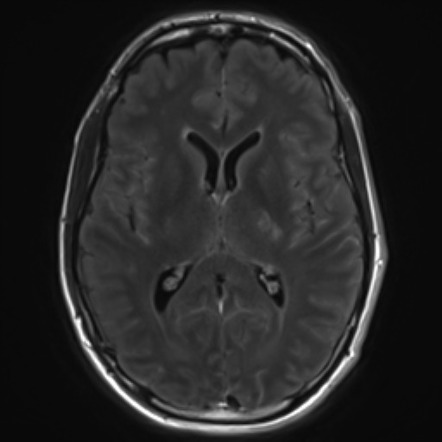 Cryptococcosis | Image | Radiopaedia.org