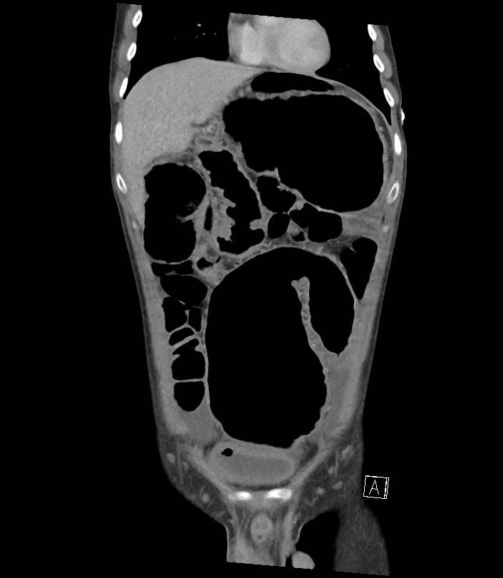 Toxic megacolon | Image | Radiopaedia.org