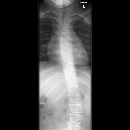 Spinal muscular atrophy 2025 type 2 zahra