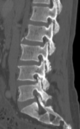 Psoriatic polyarthritis | Radiology Case | Radiopaedia.org