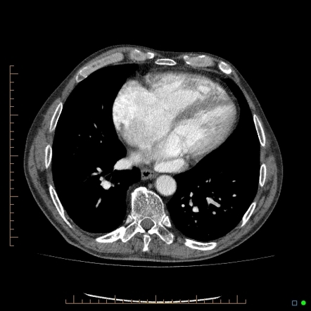 Partial anomalous pulmonary venous return (PAPVR) - entire left lung ...