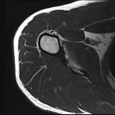 Intracortical osteoid osteoma of humeral shaft | Image | Radiopaedia.org