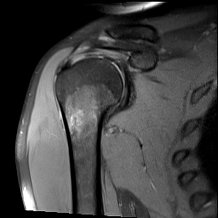 Intracortical osteoid osteoma of humeral shaft | Image | Radiopaedia.org