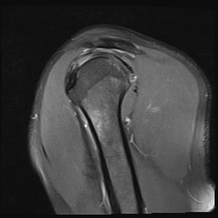 Intracortical osteoid osteoma of humeral shaft | Image | Radiopaedia.org