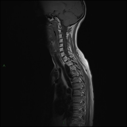 Radiation-induced MRI signal changes in bone marrow | Radiology ...