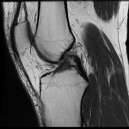 Parrot beak and displaced flap mensical tears | Image | Radiopaedia.org