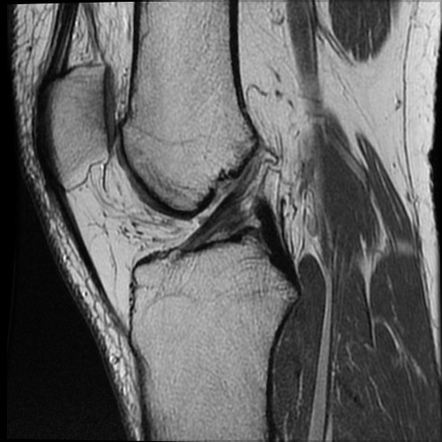 Parrot beak and displaced flap mensical tears | Image | Radiopaedia.org