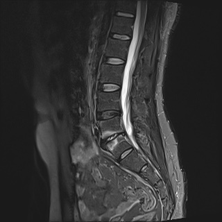 Claw sign in Modic type 1 endplate changes | Image | Radiopaedia.org