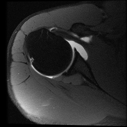 Anterior glenoid labrum tear with large paralabral cyst | Image ...