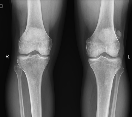 Multipartite patella | Radiology Case | Radiopaedia.org