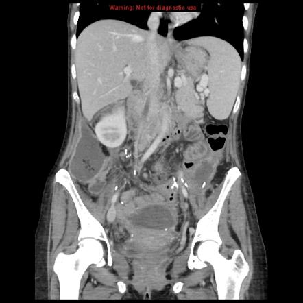 Post-operative Intra-abdominal Collections 