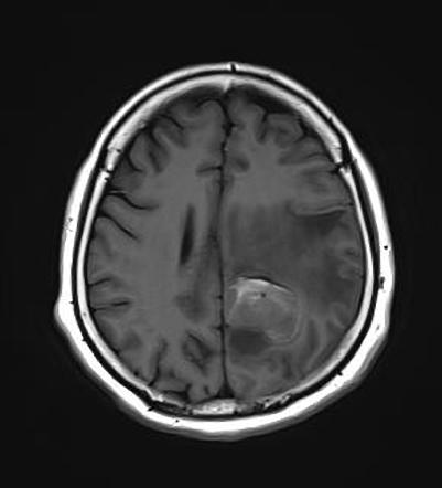 Meningeal melanoma | Radiology Case | Radiopaedia.org