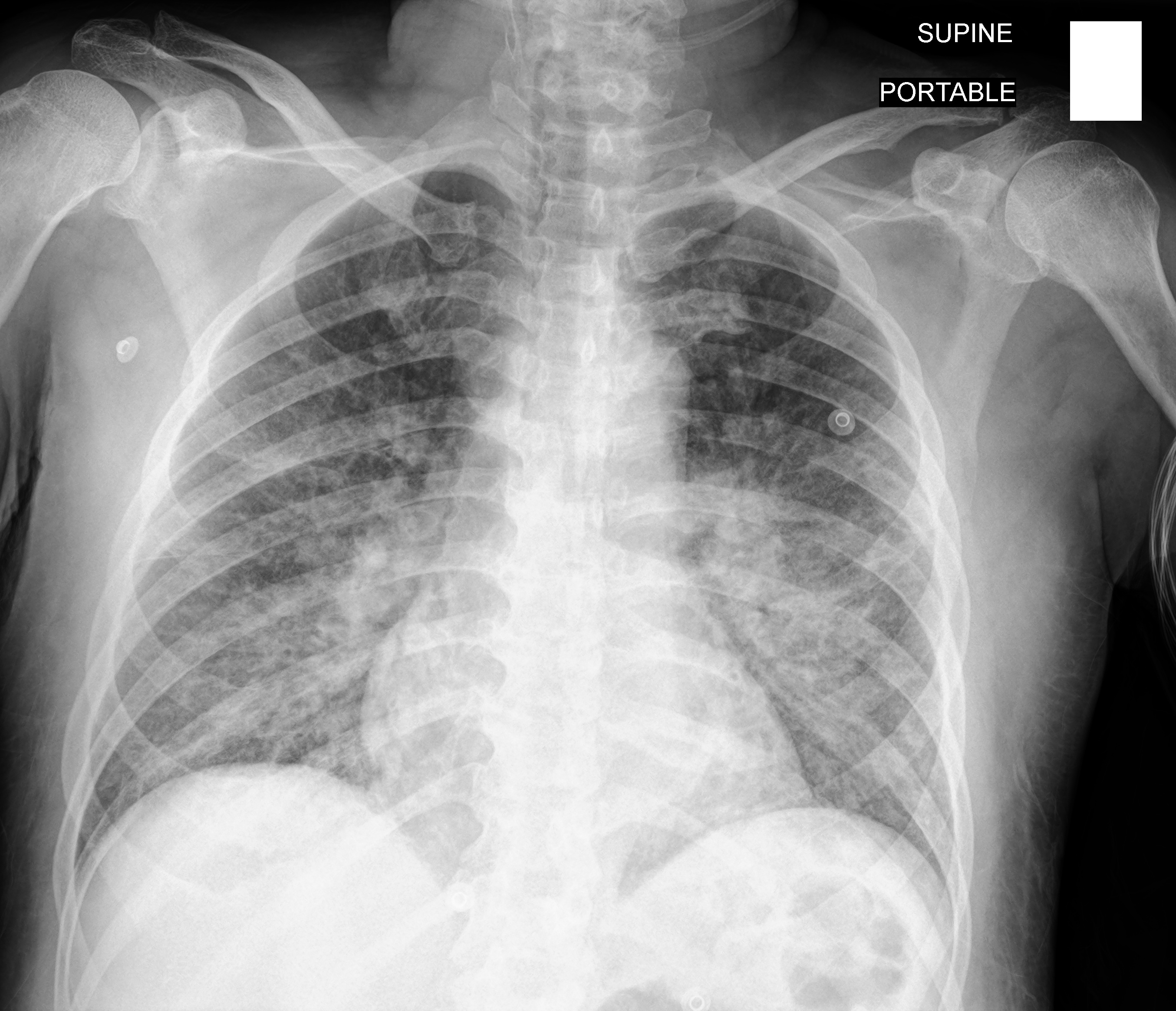 Noncardiogenic Pulmonary Edema Cxr