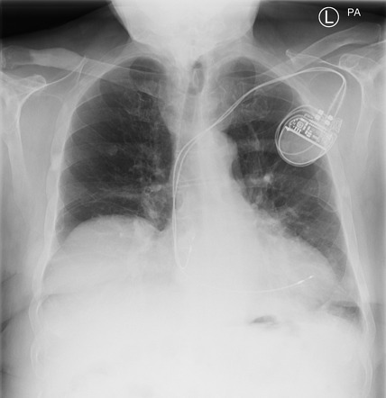 Sclerotic bone metastases - prostate cancer | Radiology Case ...