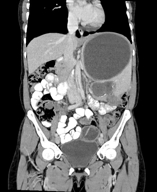 Splenic and peritoneal hydatidosis | Image | Radiopaedia.org