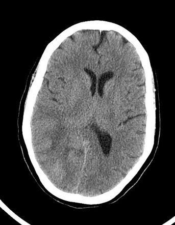 Multicentric glioblastoma | Radiology Case | Radiopaedia.org