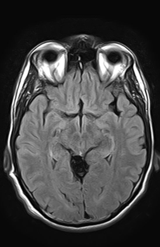 Subcortical grey matter heterotopia | Image | Radiopaedia.org