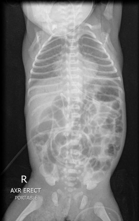 Necrotizing Enterocolitis 