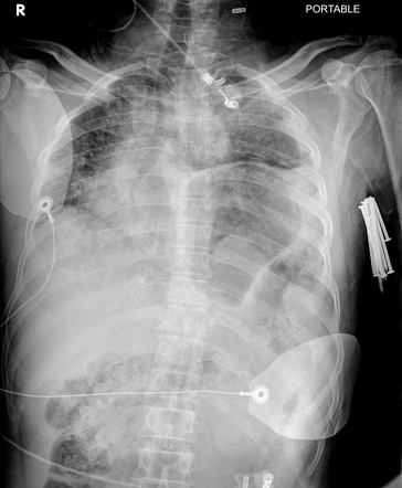 Traumatic Diaphragmatic Rupture 