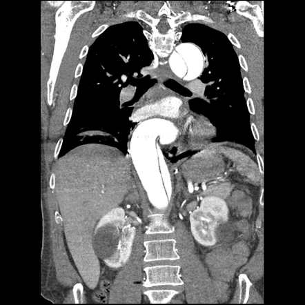 Aortic dissection - DeBakey Type I/Stanford A | Radiology Case ...