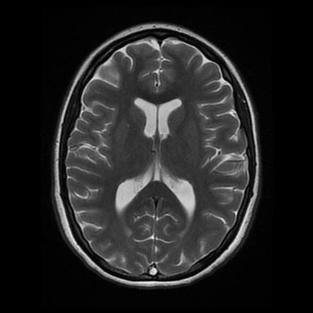 Superior sagittal and right transverse sinuses thrombosis | Image ...