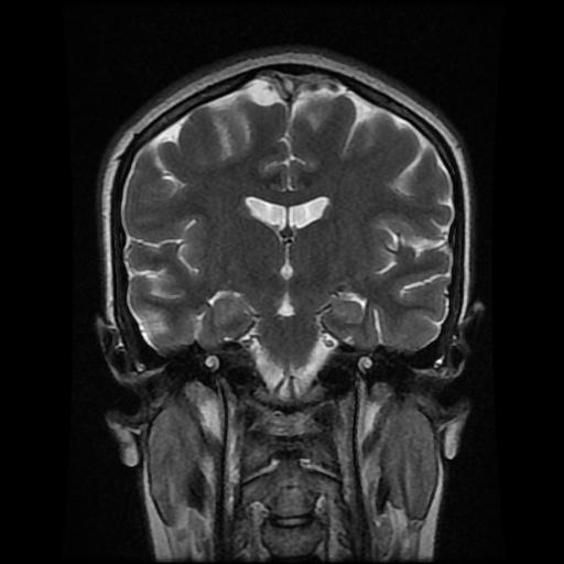 Superior Sagittal And Right Transverse Sinuses Thrombosis Image