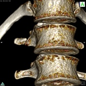 Transverse process fracture | Radiology Reference Article | Radiopaedia.org