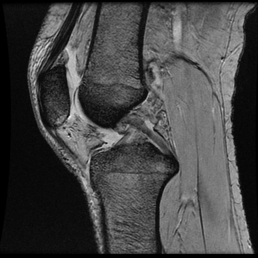 Impaction fracture and bone bruise of the proximal tibia | Image ...