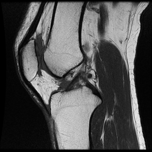 Impaction fracture and bone bruise of the proximal tibia | Image ...