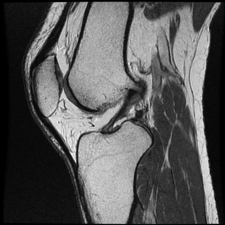 Impaction fracture and bone bruise of the proximal tibia | Image ...