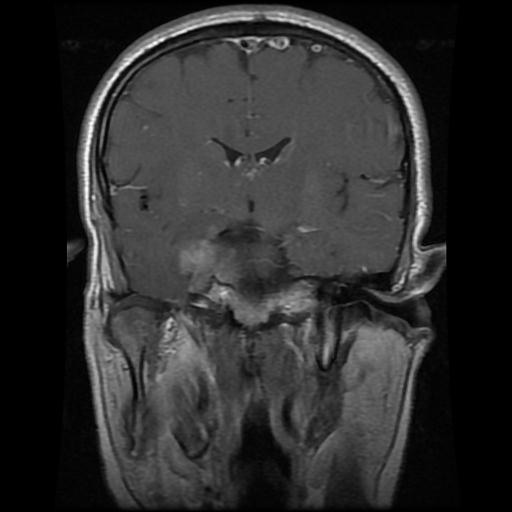 Pituitary Macroadenoma | Image | Radiopaedia.org