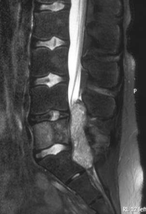 Primary bone tumors of the spine | Radiology Reference Article ...