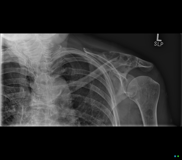 Distal clavicular erosion (differential)