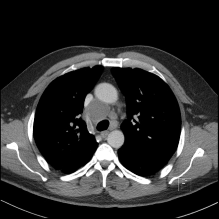 Azygos vein | Radiology Reference Article | Radiopaedia.org