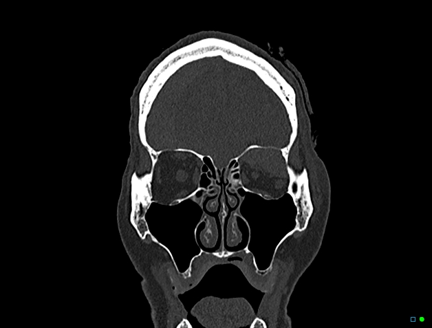 Large orbital extraconal hematoma causing proptosis | Image ...